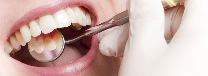 Schöne Zähne Remscheid: Vollkeramische Kronen, Bleaching