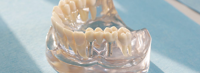 Zahnimplantate in Remscheid für feste Zähne 